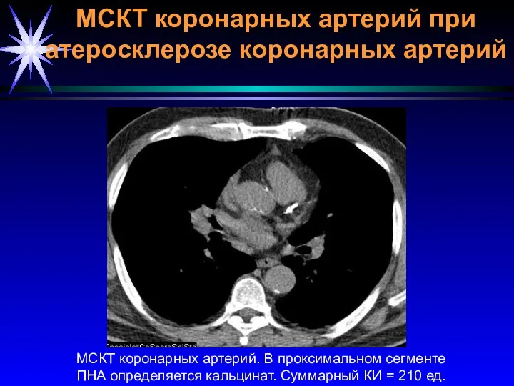 МСКТ коронарных артерий. В проксимальном сегменте ПНА определяется кальцинат. Суммарный КИ = 210