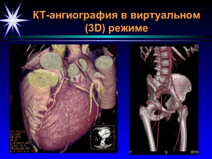 КТ-ангиография в виртуальном (3D) режиме