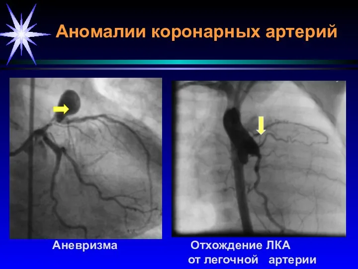 Аномалии коронарных артерий Аневризма Отхождение ЛКА от легочной артерии