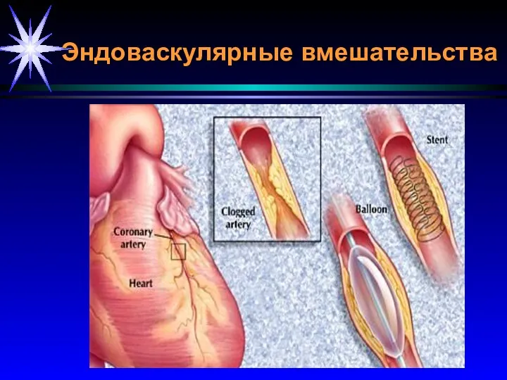 Эндоваскулярные вмешательства