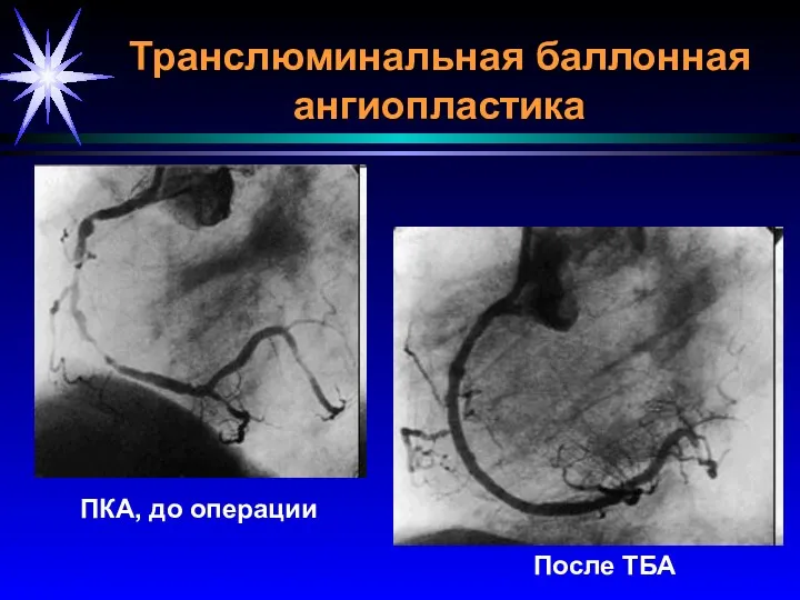 Транслюминальная баллонная ангиопластика ПКА, до операции После ТБА