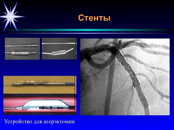 Стенты Устройство для атерэктомии