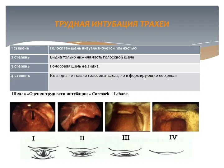 ТРУДНАЯ ИНТУБАЦИЯ ТРАХЕИ Шкала «Оценки трудности интубации » Cormack – Lehane.