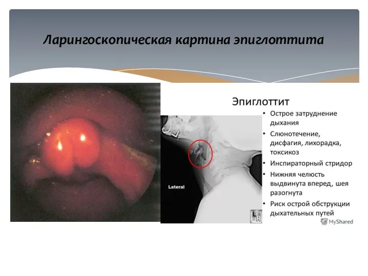 Ларингоскопическая картина эпиглоттита
