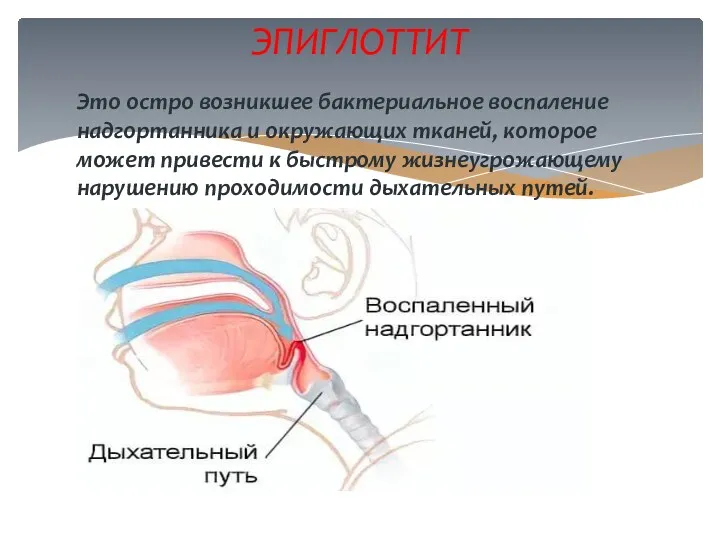 Это остро возникшее бактериальное воспаление надгортанника и окружающих тканей, которое