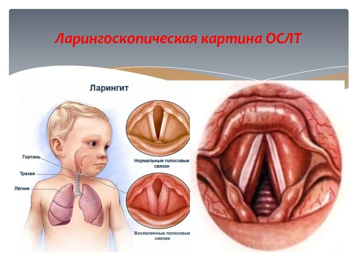 Ларингоскопическая картина ОСЛТ