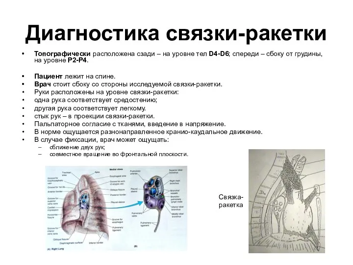 Диагностика связки-ракетки Топографически расположена сзади – на уровне тел D4-D6;