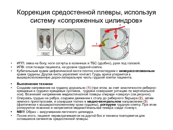 Коррекция средостенной плевры, используя систему «сопряженных цилиндров» ИПП: лежа на