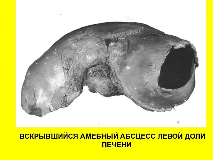 ВСКРЫВШИЙСЯ АМЕБНЫЙ АБСЦЕСС ЛЕВОЙ ДОЛИ ПЕЧЕНИ