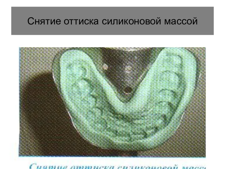 Снятие оттиска силиконовой массой