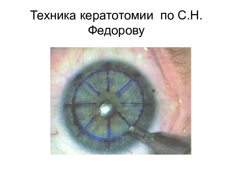 Техника кератотомии по С.Н.Федорову