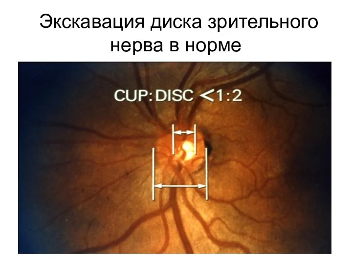 Экскавация диска зрительного нерва в норме