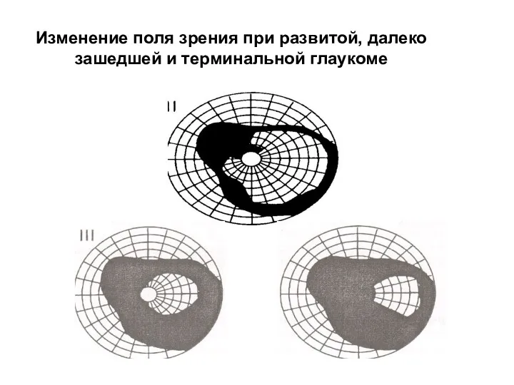 Изменение поля зрения при развитой, далеко зашедшей и терминальной глаукоме