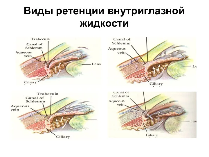 Виды ретенции внутриглазной жидкости
