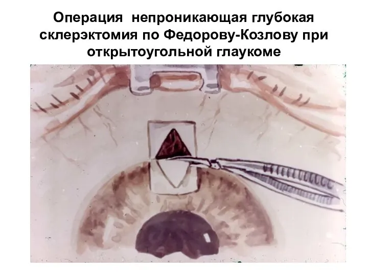 Операция непроникающая глубокая склерэктомия по Федорову-Козлову при открытоугольной глаукоме