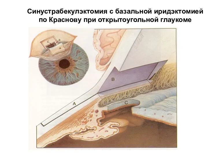 Синустрабекулэктомия с базальной иридэктомией по Краснову при открытоугольной глаукоме