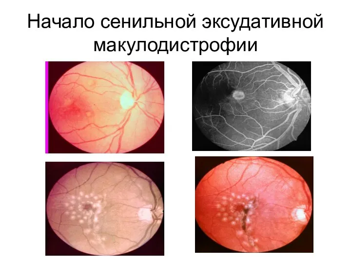 Начало сенильной эксудативной макулодистрофии