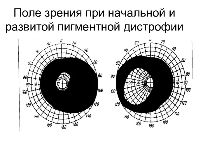 Поле зрения при начальной и развитой пигментной дистрофии