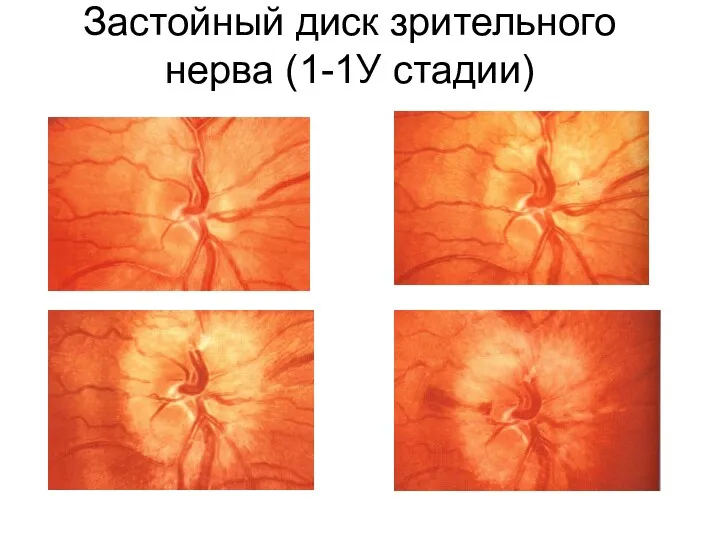 Застойный диск зрительного нерва (1-1У стадии)