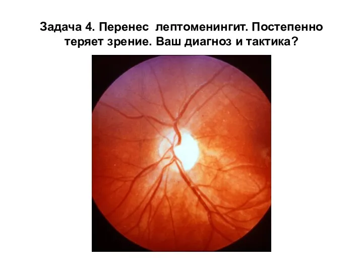 Задача 4. Перенес лептоменингит. Постепенно теряет зрение. Ваш диагноз и тактика?