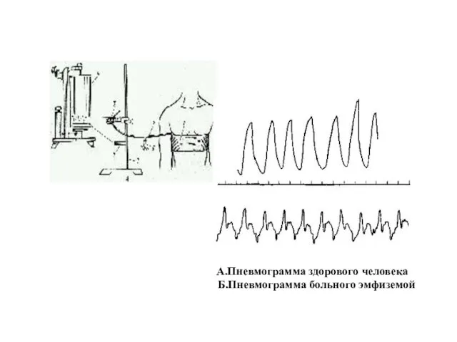 А.Пневмограмма здорового человека Б.Пневмограмма больного эмфиземой