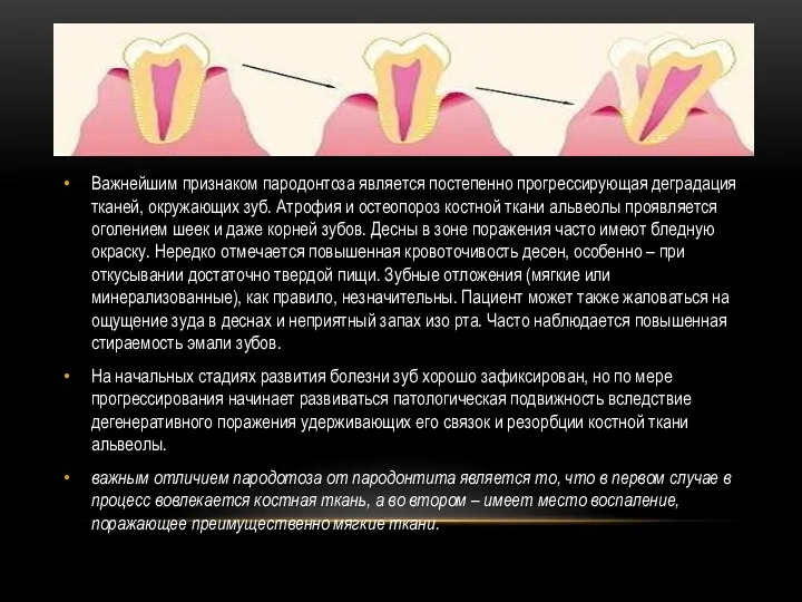 Важнейшим признаком пародонтоза является постепенно прогрессирующая деградация тканей, окружающих зуб.