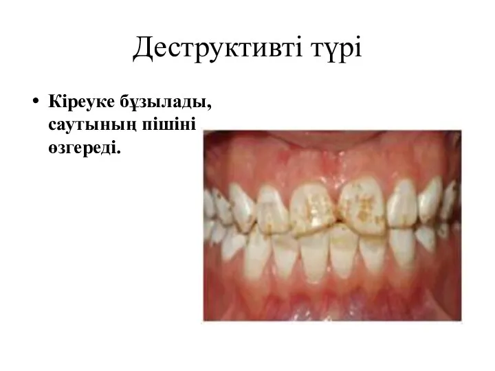 Деструктивті түрі Кіреуке бұзылады, саутының пішіні өзгереді.