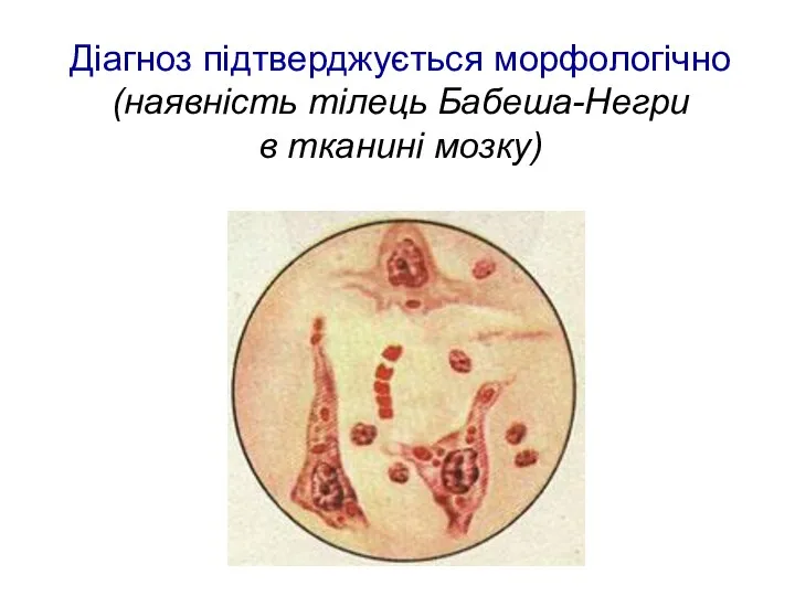 Діагноз підтверджується морфологічно (наявність тілець Бабеша-Негри в тканині мозку)