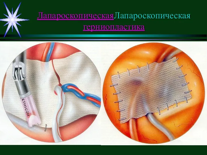 ЛапароскопическаяЛапароскопическая герниопластика