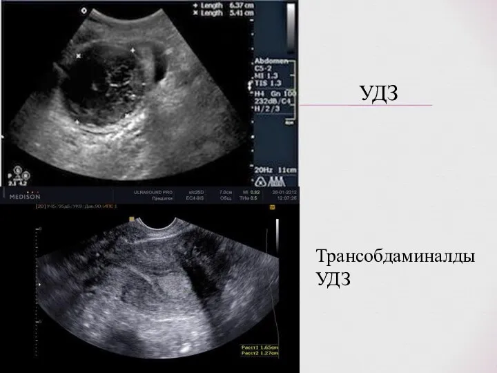 УДЗ Трансобдаминалды УДЗ