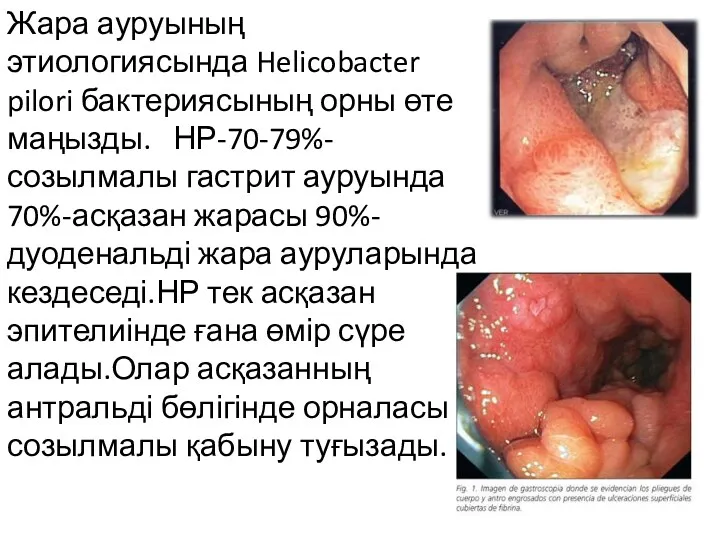 Жара ауруының этиологиясында Helicobacter pilori бактериясының орны өте маңызды. НР-70-79%-созылмалы
