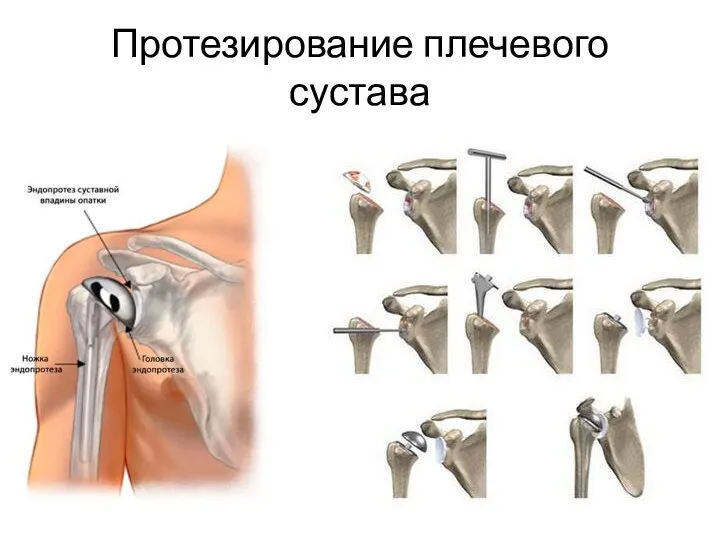 Протезирование плечевого сустава