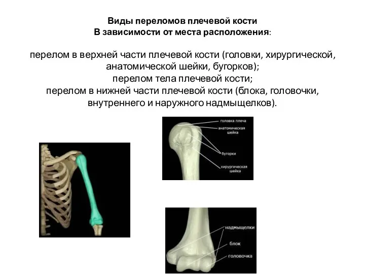 Виды переломов плечевой кости В зависимости от места расположения: перелом в верхней части