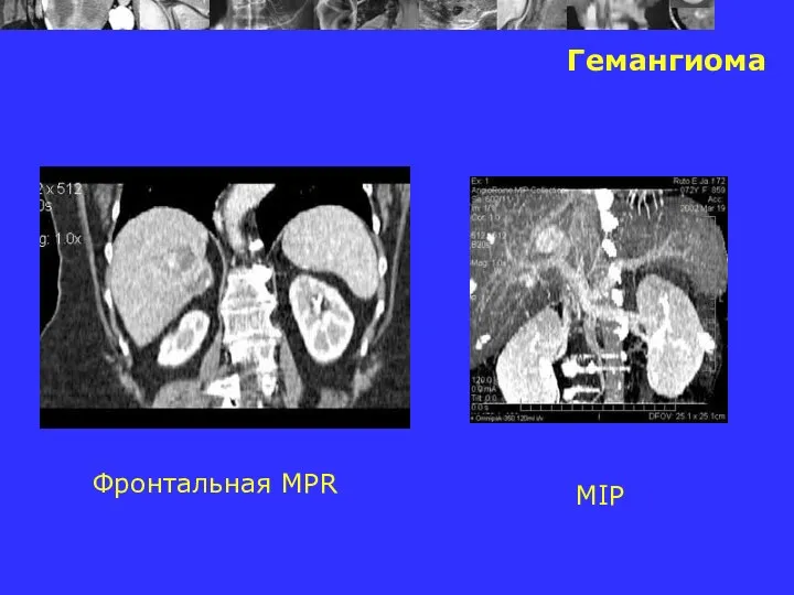 Гемангиома Фронтальная MPR MIP