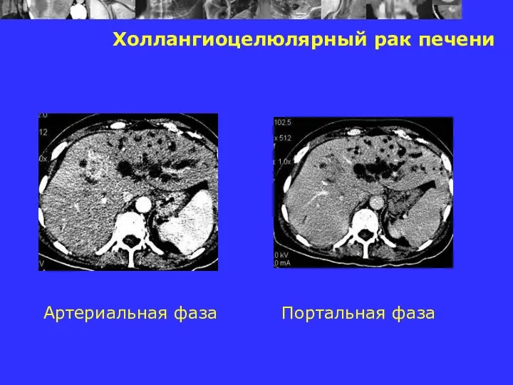 Холлангиоцелюлярный рак печени Артериальная фаза Портальная фаза