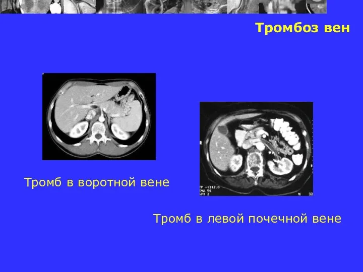 Тромбоз вен Тромб в воротной вене Тромб в левой почечной вене