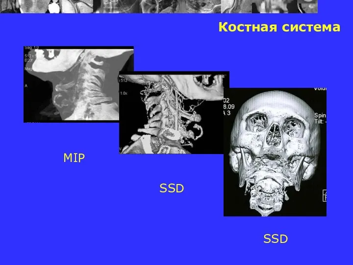 Костная система MIP SSD SSD