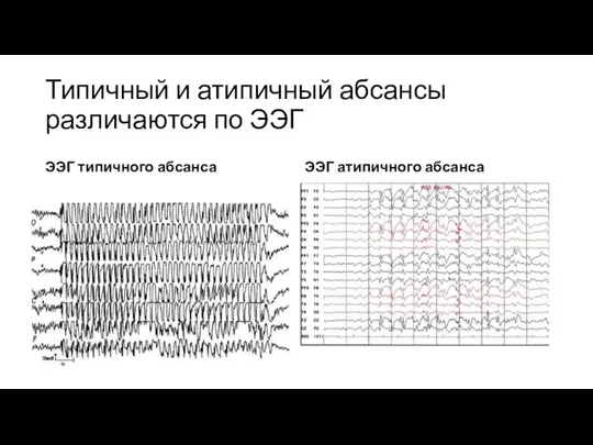 Типичный и атипичный абсансы различаются по ЭЭГ ЭЭГ типичного абсанса ЭЭГ атипичного абсанса