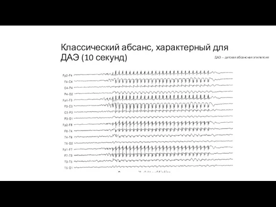 Классический абсанс, характерный для ДАЭ (10 секунд) ДАЭ – детская абсансная эпилепсия