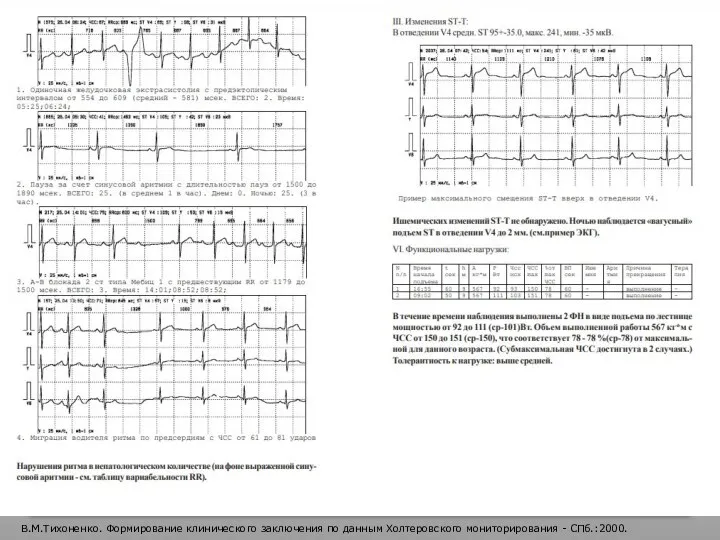 В.М.Тихоненко. Формирование клинического заключения по данным Холтеровского мониторирования - СПб.:2000.
