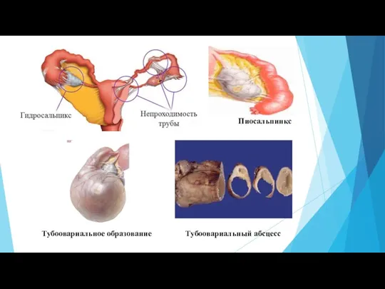 Пиосальпинкс Тубоовариальный абсцесс Тубоовариальное образование