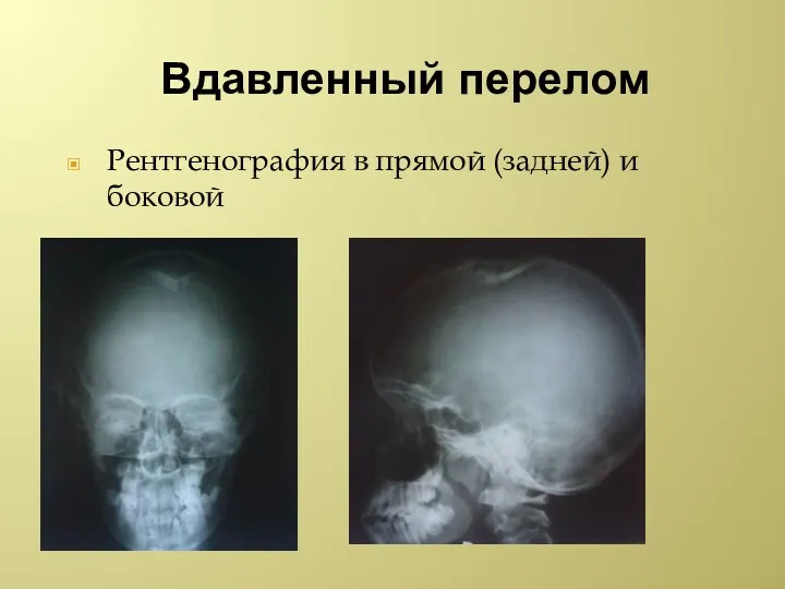 Вдавленный перелом Рентгенография в прямой (задней) и боковой