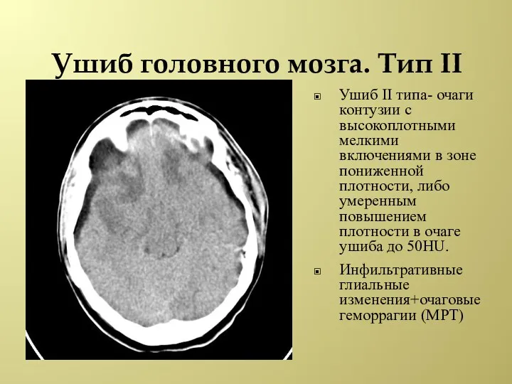 Ушиб головного мозга. Тип II Ушиб II типа- очаги контузии