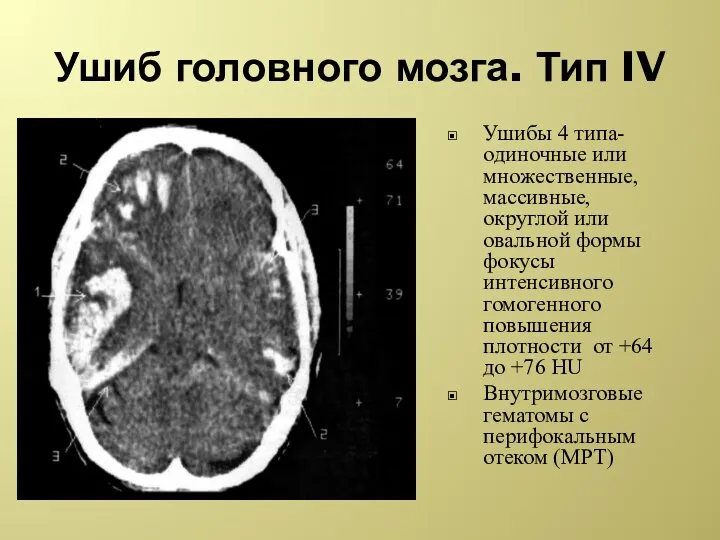 Ушиб головного мозга. Тип IV Ушибы 4 типа- одиночные или