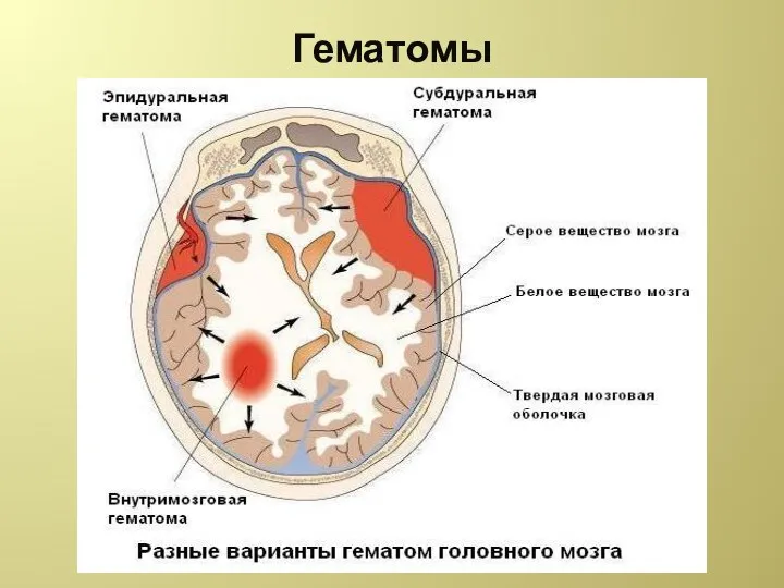 Гематомы