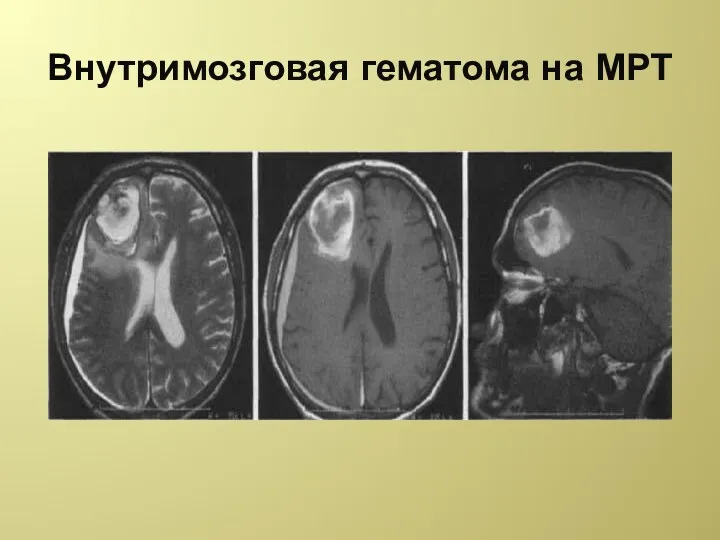 Внутримозговая гематома на МРТ