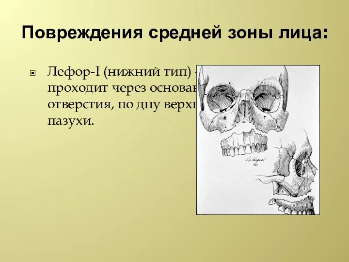 Повреждения средней зоны лица: Лефор-I (нижний тип) - щель перелома