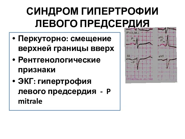 СИНДРОМ ГИПЕРТРОФИИ ЛЕВОГО ПРЕДСЕРДИЯ Перкуторно: смещение верхней границы вверх Рентгенологические