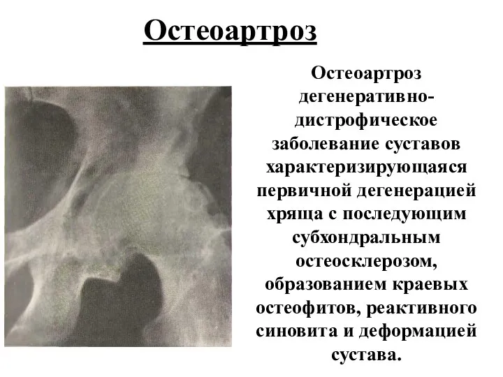 Остеоартроз Остеоартроз дегенеративно- дистрофическое заболевание суставов характеризирующаяся первичной дегенерацией хряща