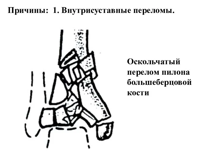 Причины: 1. Внутрисуставные переломы. Оскольчатый перелом пилона большеберцовой кости